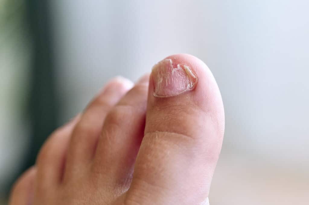 Elimina Hongos en Uñas de los pies