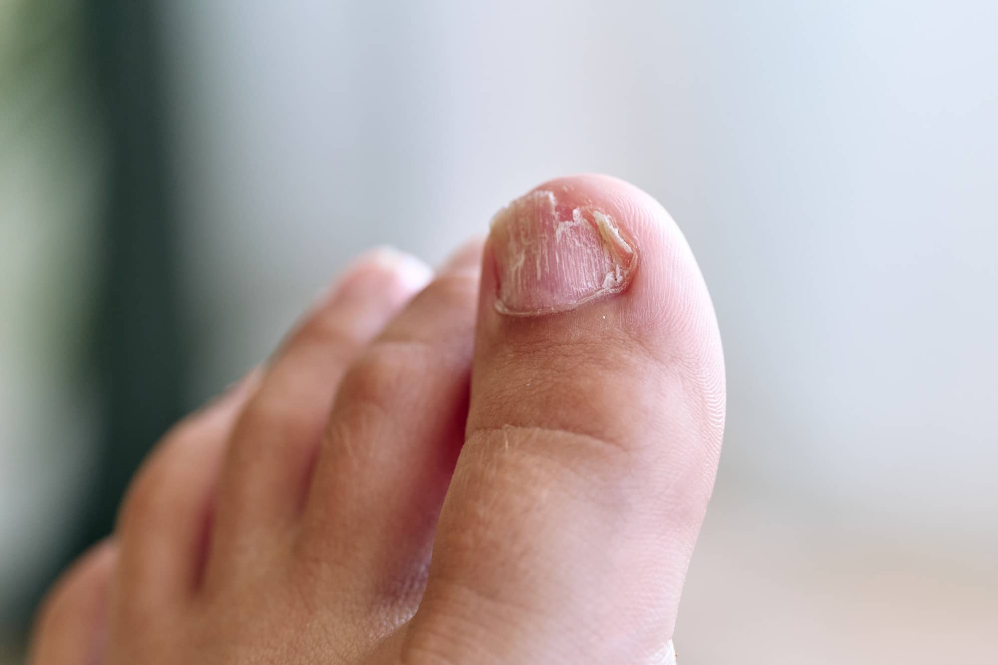 Elimina Hongos en Uñas de los pies