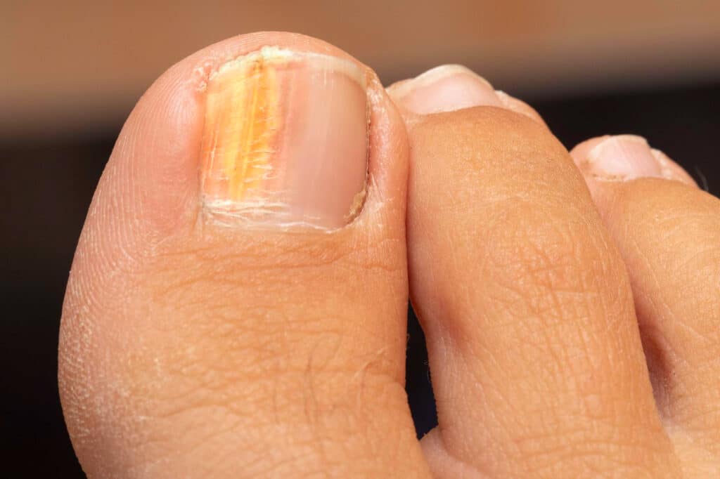 Eliminación Hongos los pies