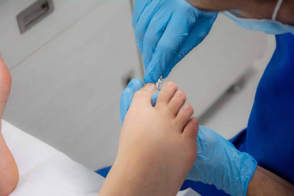 Tratamiento para Uña Encarnada Dr. Scholl's
