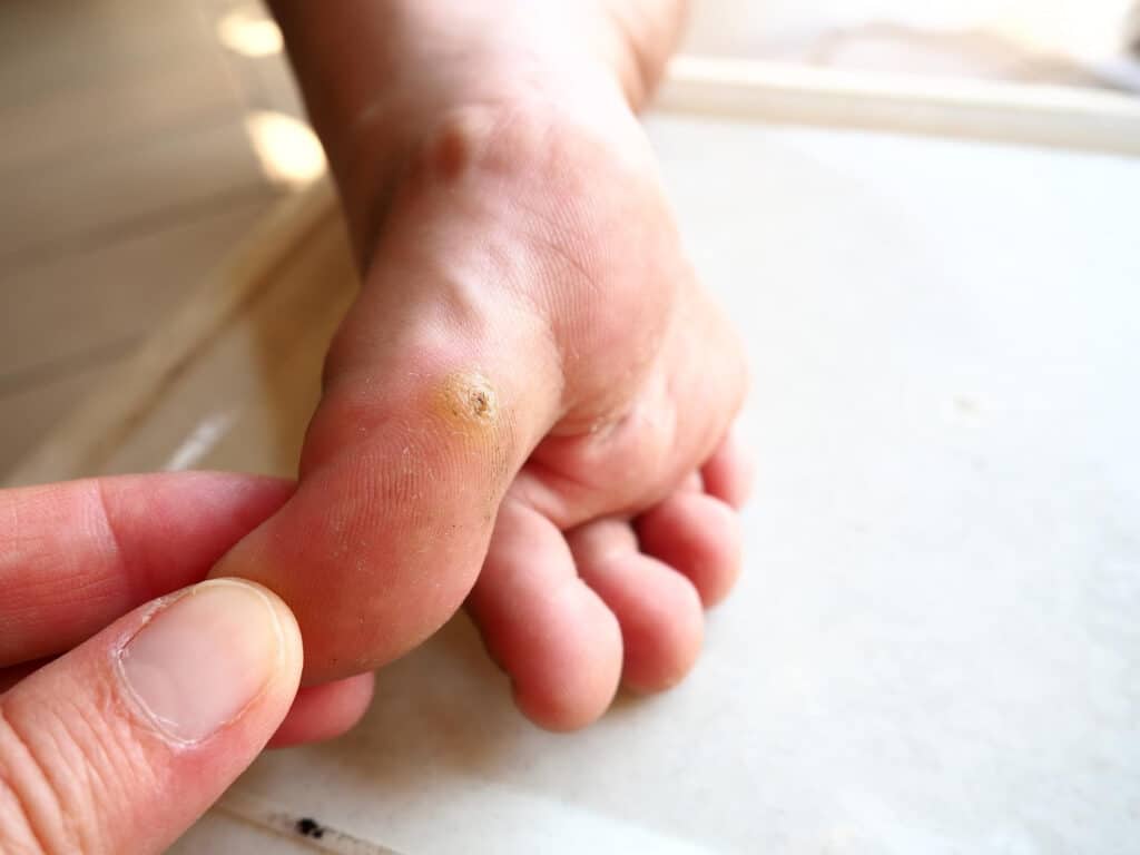 Verruga plantar Dr. Scholls